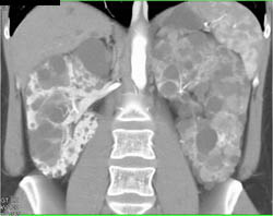 Pck With Infected Cysts Left Kidney - CTisus CT Scan