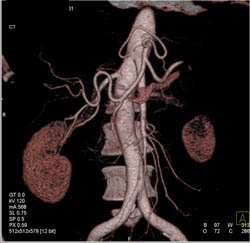 Multiple Renal Arteries - CTisus CT Scan