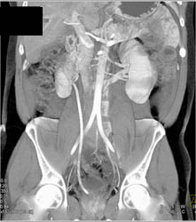 Stent in Renal Pelvis Displaced Medially Due to Retroperitoneal Fibrosis - CTisus CT Scan