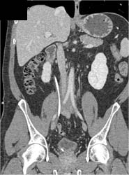 Incidental Arteriovenous Malformation (AVM) - CTisus CT Scan