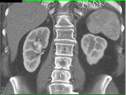 Residual Renal Cell Carcinoma - CTisus CT Scan