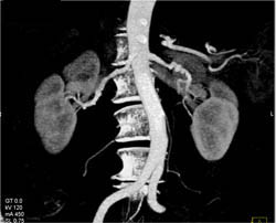 Fibromuscular Dysplasia Right and Left - CTisus CT Scan