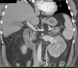 Transitional Cell Cancer (TCC) Left Kidney - CTisus CT Scan