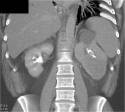 Blood Clot in Left Renal Pelvis - CTisus CT Scan