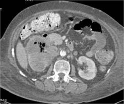 Necrosis Tumor Left Kidney - CTisus CT Scan