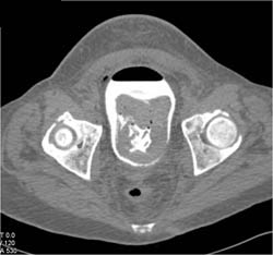 Bladder Hematoma and Laceration of Bladder - CTisus CT Scan