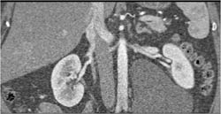 Mesenteric Cyst - CTisus CT Scan