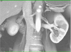 Prehilar Branching Left Renal Artery and Retroaortic Rv - CTisus CT Scan