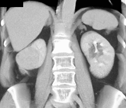 Renal Cell Carcinoma - CTisus CT Scan