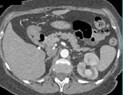 Renal Cell Carcinoma - CTisus CT Scan