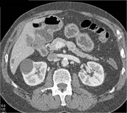 Renal Cyst - CTisus CT Scan