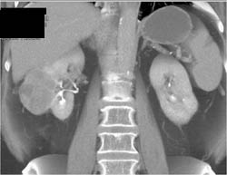 Cystic Renal Cell Carcinoma (RCC) - CTisus CT Scan