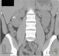 Calcification With Evidence of Mass Which Is A Complex Cyst - CTisus CT Scan