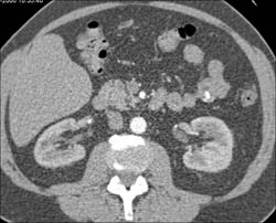 Renal Cyst - CTisus CT Scan