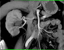 Renal Infarct Right Kidney - CTisus CT Scan