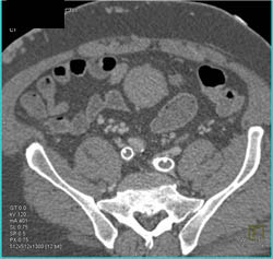 IVC Occlusion With Collaterals Around Kidney - CTisus CT Scan