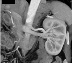 Normal Renal Vein on VRT and MIP - CTisus CT Scan