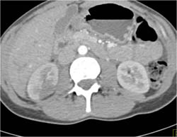 Acute Pyelonephritis - CTisus CT Scan