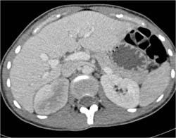 Acute Pyelonephritis - CTisus CT Scan