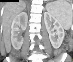 Acute Pyelonephritis - CTisus CT Scan