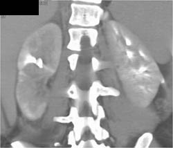 Acute Pyelonephritis - CTisus CT Scan