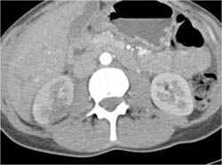 Acute Pyelonephritis - CTisus CT Scan