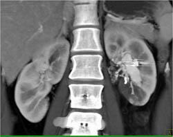 Renal Arteriovenous Malformation (AVM) With Embolization - CTisus CT Scan