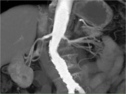 Renal Artery Stenosis - CTisus CT Scan