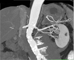 Renal Artery Stenosis - CTisus CT Scan