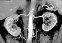 Renal Donor Study - CTisus CT Scan