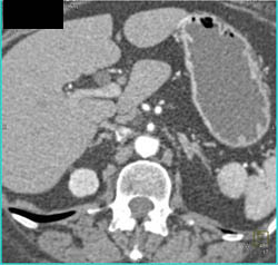 Renal Cell Carcinoma Off Upper Pole Right Kidney and Easy to Miss on Axial Images - CTisus CT Scan