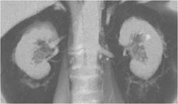 Stranding Near Kidneys - CTisus CT Scan