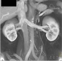 Normal Renal Veins With Two Right Renal Veins - CTisus CT Scan