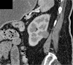 Renal Cell Carcinoma - CTisus CT Scan