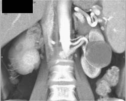 Renal Cell Carcinoma - CTisus CT Scan