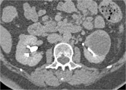 Cystic Renal Cell Carcinoma (RCC) - CTisus CT Scan