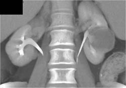 Cystic Renal Cell Carcinoma (RCC) - CTisus CT Scan