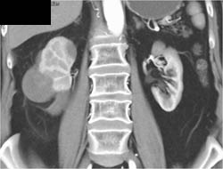 Renal Cell Carcinoma Vs Lymphoma- Diagnosis Is Lymphoma - CTisus CT Scan