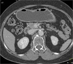 Acute Pyelonephritis Vs Focal Infarct- Diagnosis Is Infarct - CTisus CT Scan