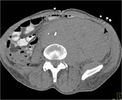 Infiltration of the Perirenal Space By Extramedullary Myeloma- Differential Diagnosis Includes Lymphoma - CTisus CT Scan