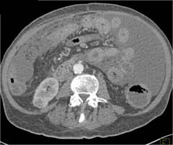 Renal Cell Carcinoma - CTisus CT Scan