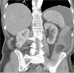 Renal Cell Carcinoma - CTisus CT Scan