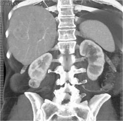 Renal Cell Carcinoma - CTisus CT Scan