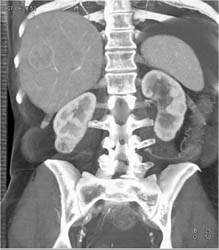 Renal Cell Carcinoma - CTisus CT Scan