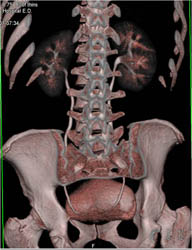 Normal CT Urogram - CTisus CT Scan