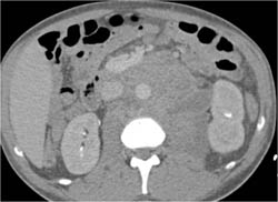 Tuberculosis (TB) With Cystic Nodes - CTisus CT Scan