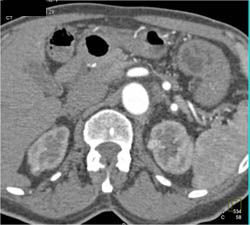 Several 1 Cm Renal Cell Carcinomas (RCC) in Both Kidneys- Multifocal RCC - CTisus CT Scan