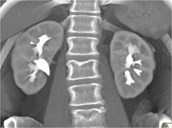 Normal CT Urogram - CTisus CT Scan