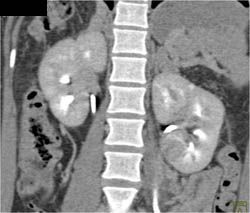 Acute Pyelonephritis - CTisus CT Scan