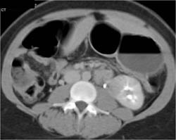 Acute Pyelonephritis - CTisus CT Scan